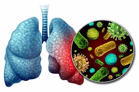 Pneumonia_Infection_Anatomy_480x320_Q50